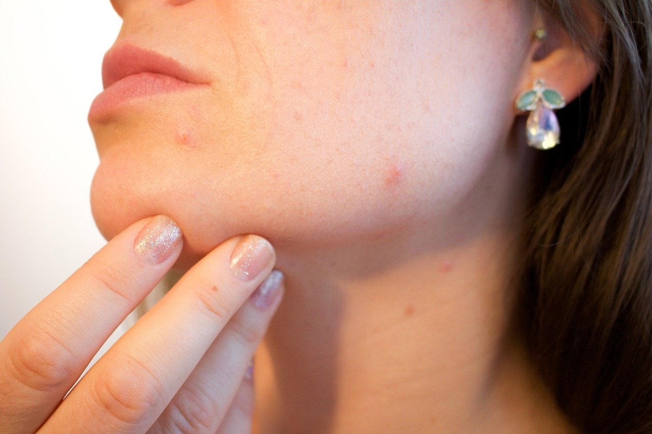 Kyste sébacé du visage que faire pour l’enlever ? Floxia Paris