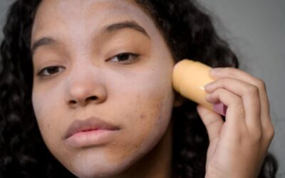 Comment reconnaître l’acné hormonale ?